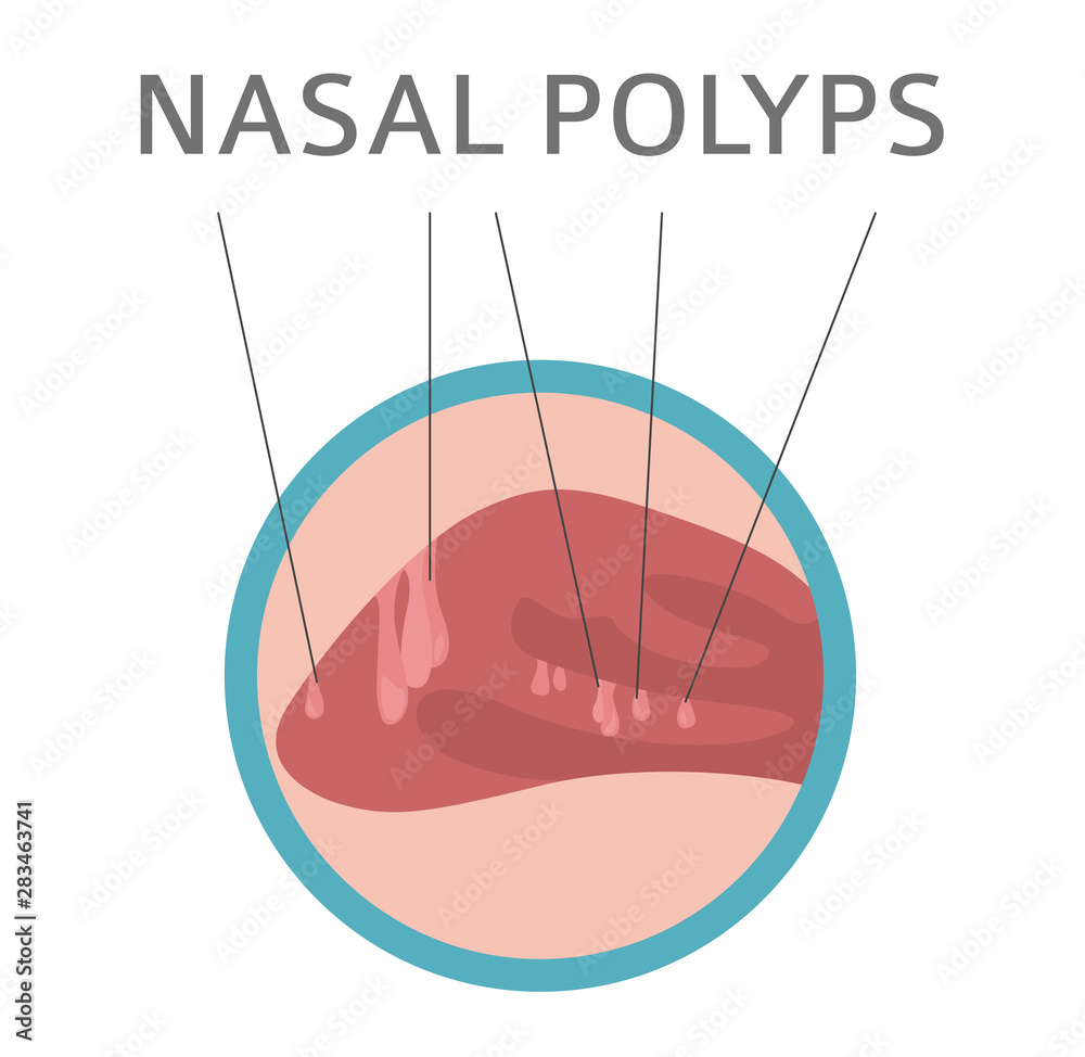 Nasal diseases. Nasal polyps causes, diagnosis and treatment medical infographic design