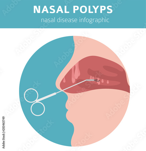 Nasal diseases. Nasal polyps causes, diagnosis and treatment medical infographic design