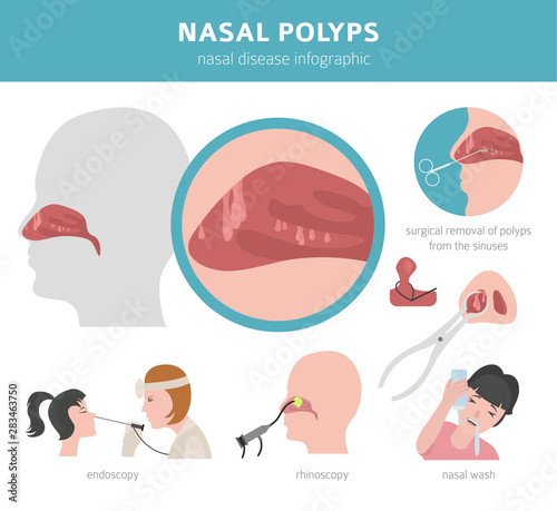Nasal diseases. Nasal polyps causes, diagnosis and treatment medical infographic design