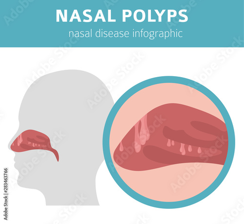 Nasal diseases. Nasal polyps causes, diagnosis and treatment medical infographic design