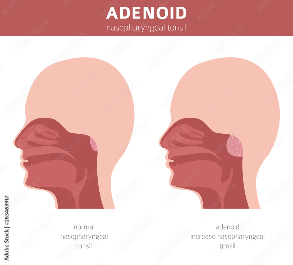 Nasal and throat, nasopharynx diseases. Adenoids diagnosis and treatment medical infographic design