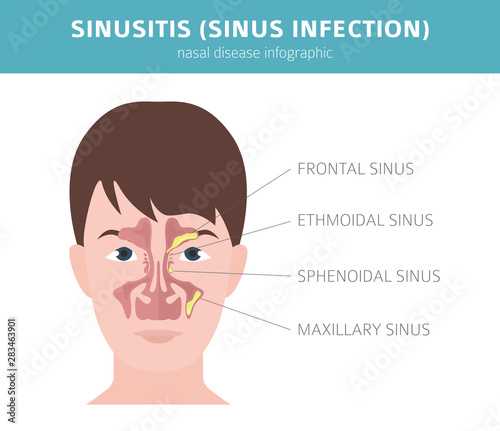 Nasal diseases. Sinusitis, sinus infection diagnosis and treatment medical infographic design