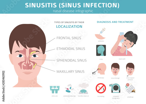 Nasal diseases. Sinusitis, sinus infection diagnosis and treatment medical infographic design