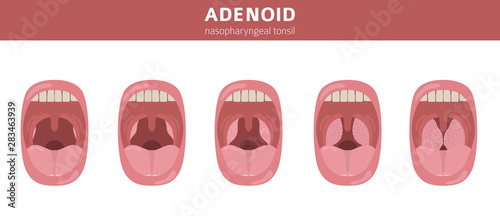 Nasal and throat, nasopharynx diseases. Adenoids diagnosis and treatment medical infographic design photo