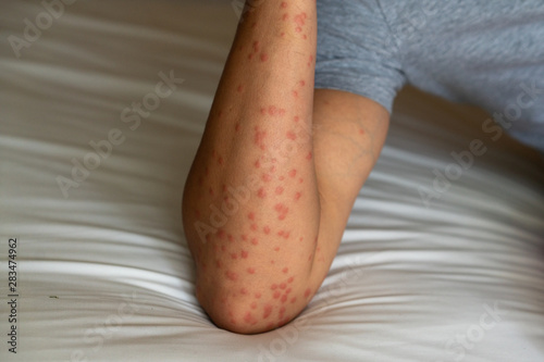 Close up of redness, itching and swelling after many mosquitos bite on the arm - allergy to mosquito saliva can cause papular hives or Skeeter's syndrome. photo