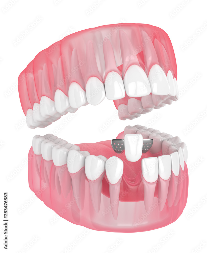 3d render of jaw with teeth and maryland bridge 3d render of jaw with teeth and maryland bridge