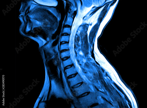Magnetic resonance imaging of the cervical spine.