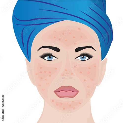 Rosacea moderate on a woman face