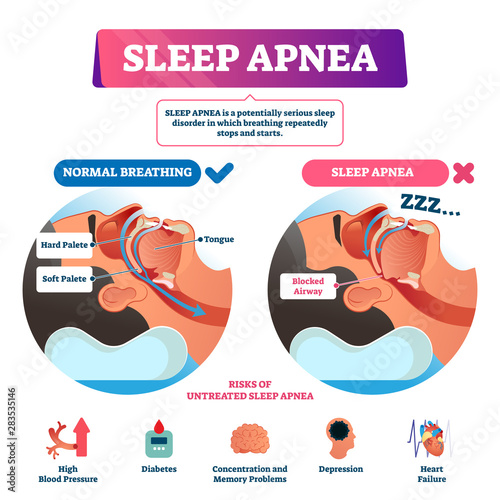 Sleep apnea vector illustration. Labeled nasal tongue blocked airway scheme