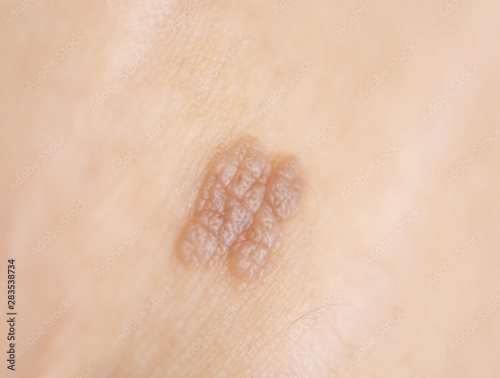 Fototapeta premium Skin looks puffy brown without pain.