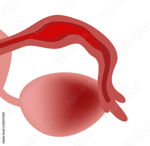 Salpingitis. Inflammation of the fallopian tube. Oophoritis. the ovary. pelvic organs. Infographics. Vector illustration on isolated background photo