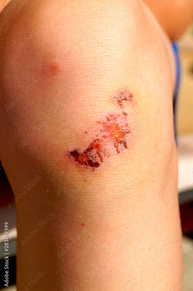 Fototapeta premium Dried blood on the scratch on the knee after falling.