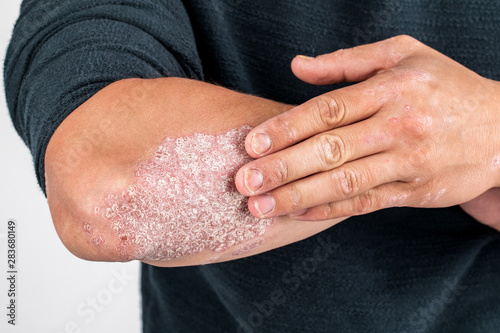 Man with sick hands, dry flaky skin on his hand with vulgar psoriasis, eczema and other skin diseases such as fungus, plaque, rash and blemishes. Autoimmune genetic disease photo