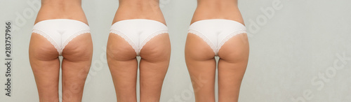 Female buttocks before and after treatment. panoramic photo