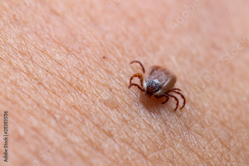 Tick filled with blood sitting on human skin.