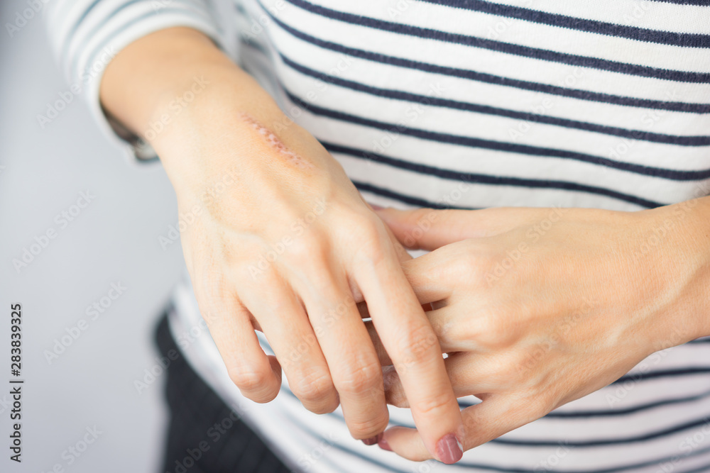 Close up of cooking oil burn scar on a woman's hands. The skin damage