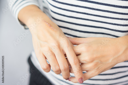 Close up of cooking oil burn scar on a woman's hands. The skin damage in first-degree on outer layer skin. Healing, Removal, Treatment, Accident in the kitchen, Scar, Scald, Wound Healing concept.