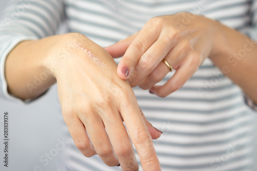 Photo Close up of cooking oil burn scar on a woman's hands