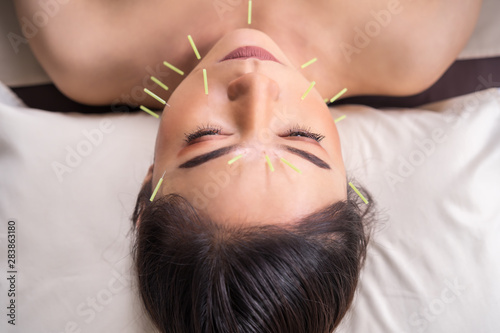 Obraz na plátne woman undergoing acupuncture treatment on face