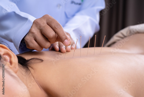 woman undergoing acupuncture treatment on back