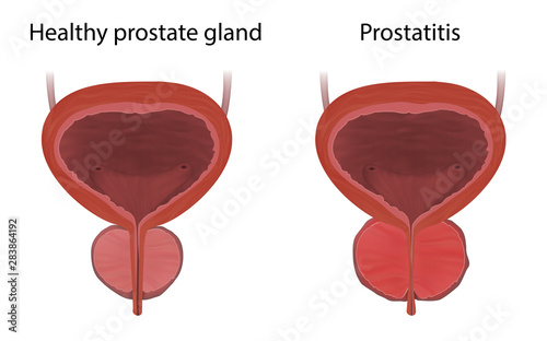 Prostatitis and healthy prostate gland, comparison. Inflammation, infection. Realistic vector medical illustration.