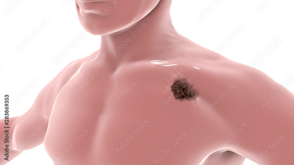 Melanoma on a male body, a cancer developing from pigment-containing cells melanocytes, 3D illustration Melanoma on a male body, a cancer developing from pigment-containing cells melanocytes, 3D illustration
