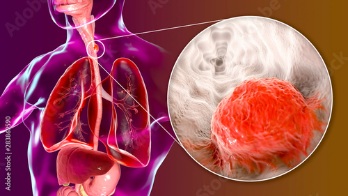 Obraz na plátne Esophageal cancer, 3D illustration showing malignant tumor in the human esophagu