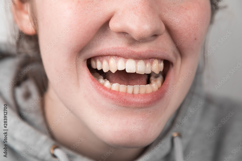 Fototapeta premium Problem teeth at the young girl. A curve row and the wrong bite an occasion to visit the dentist and the orthodontist