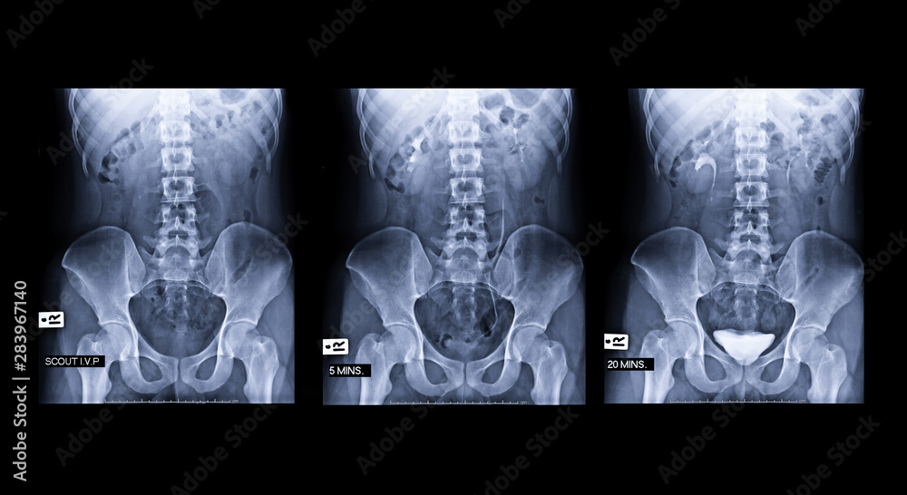 Comparison of Intravenous pyelogram or I.V.P is an X-ray exam of urinary tract after injection contrast media agent 0,5,20 minute.