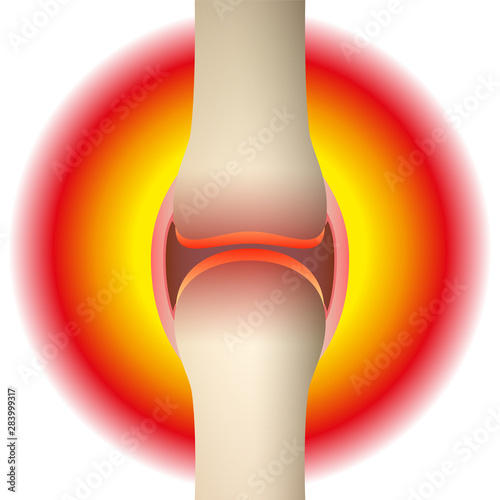 Joint pain - schematic anatomical graphic of a synovial joint with arthritis, rheumatism, gout, osteoarthritis or inflammation. Isolated vector illustration on white background.