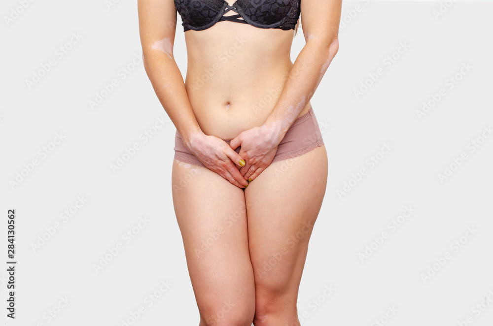 Woman with powerful hips in underwear vitiligo on skin experiences pain,  discomfort in the bikini zone, vagina, stomach. Gynecological disease, urine,  need to pee Photos