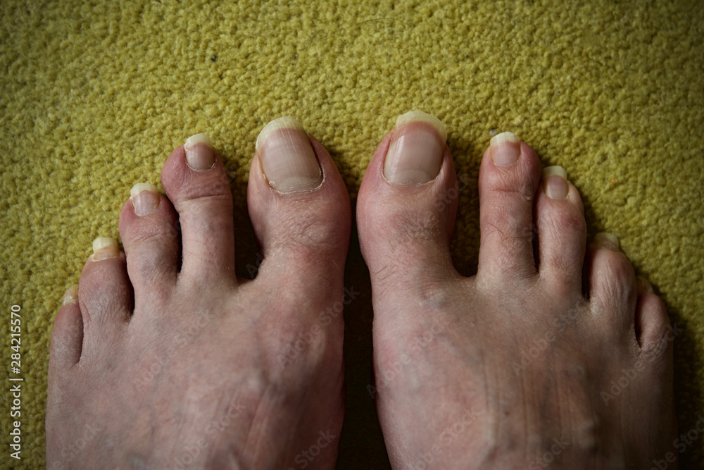 Mens feet with long toenails on yellow carpet Stock Photo | Adobe Stock
