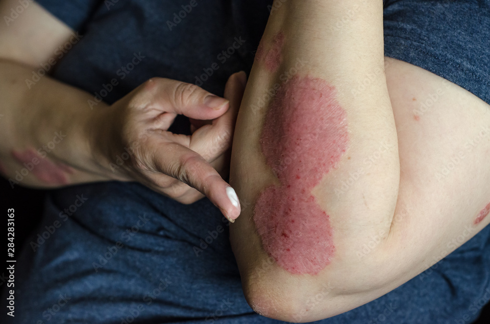 Dermatological skin disease. psoriasis, eczema, dermatitis, allergies. Skin lesions on the elbows. Dermatological skin disease. psoriasis, eczema, dermatitis, allergies. Skin lesions on the elbows.