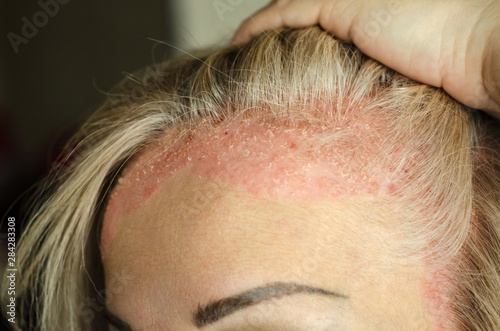 Dermatological skin disease. psoriasis, eczema, dermatitis, allergies. Skin lesions on the head. photo