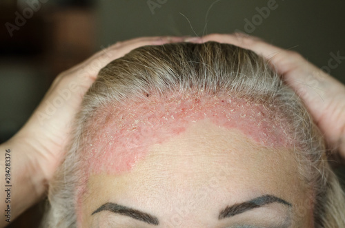 Dermatological skin disease. psoriasis, eczema, dermatitis, allergies. Skin lesions on the head. photo