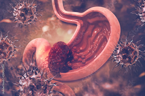 Obraz na płótnie Stomach cancer. Cancer attacking cell. Stomach disease concept