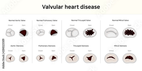 Valvular heart disease. valvular stenosis photo