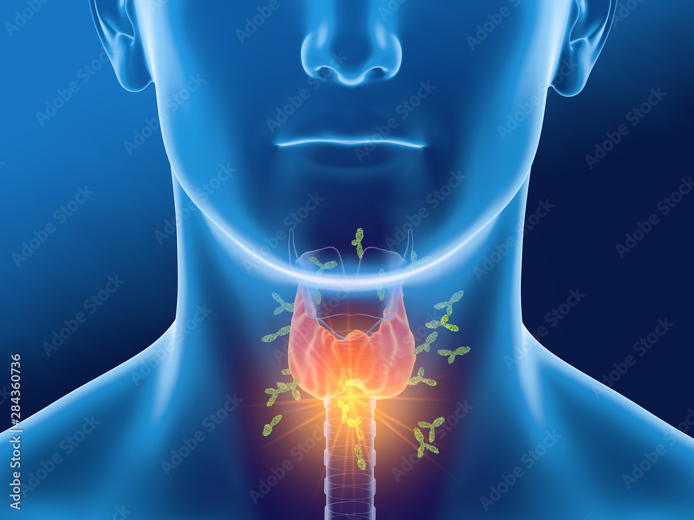Antibodies attacking thyroid gland of a woman, Autoimmune thyroiditis