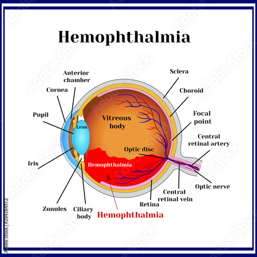 Hemophthalmia -  the presence of blood in the vitreous body (sometimes called hemorrhage in the eyeball).