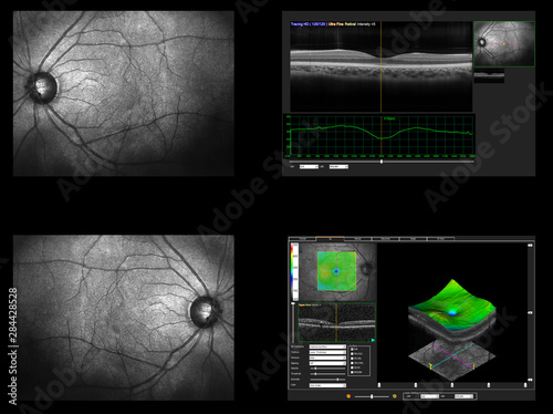 Ophthalmic test - OCT optical coherence tomography measurement. Scan of the macula in retina, layers and thickness of retina. photo