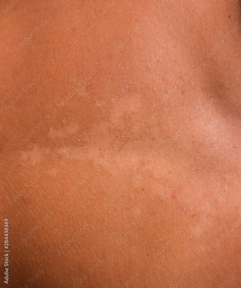 Sunburn on the skin of the stomach. Exfoliation, skin peels off. Dangerous sun tan Sunburn on the skin of the stomach. Exfoliation, skin peels off. Dangerous sun tan