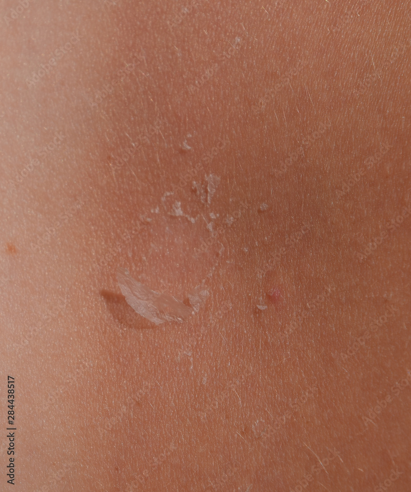 Fototapeta premium Sunburn on the skin of the back. Exfoliation, skin peels off. Dangerous sun tan