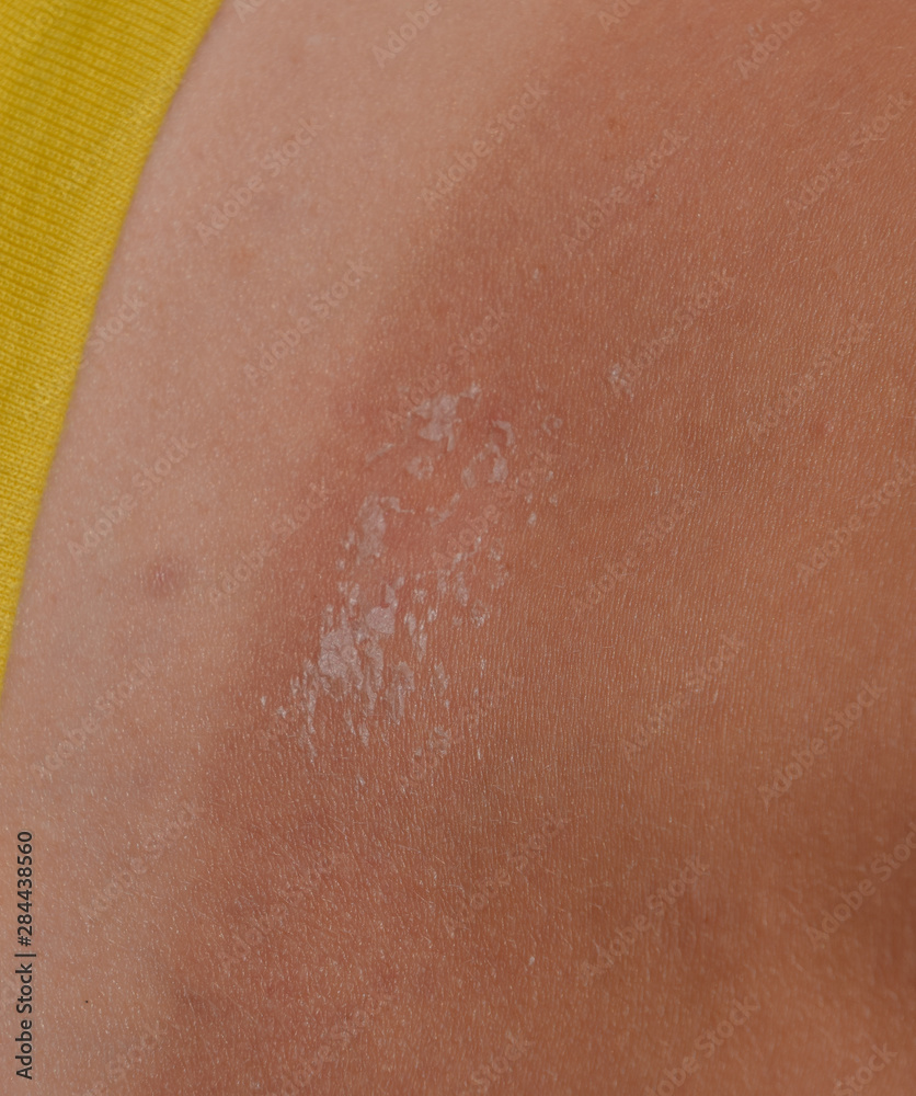 Fototapeta premium Sunburn on the skin of the back. Exfoliation, skin peels off. Dangerous sun tan