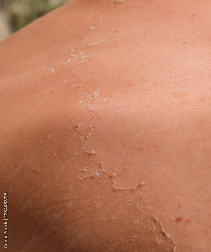 Sunburn on the skin of the back. Exfoliation, skin peels off. Dangerous sun tan Sunburn on the skin of the back. Exfoliation, skin peels off. Dangerous sun tan