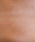 Sunburn on the skin of the back. Exfoliation, skin peels off. Dangerous sun tan