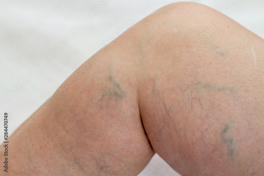 Fototapeta premium patient with varicose veins on legs