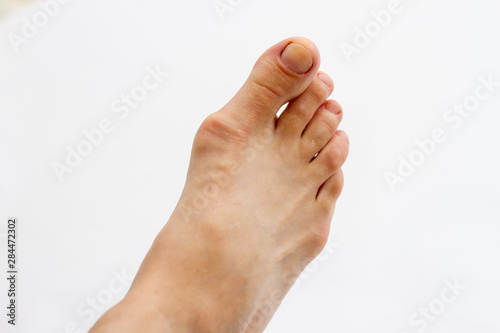 foot with gout on the bones © epovdima
