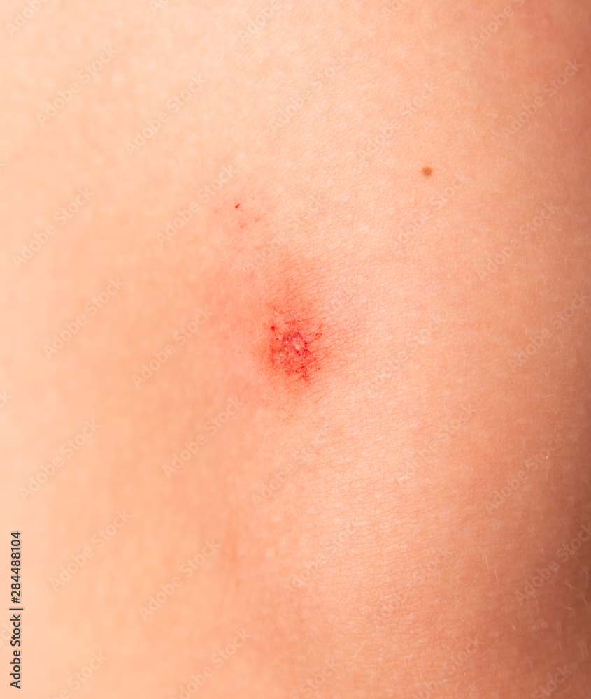 Fototapeta premium scratches on the skin of a child