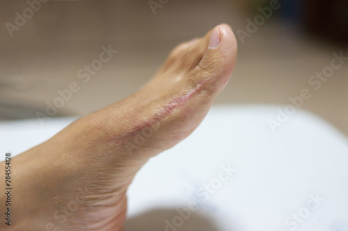 Scar of an Asian girl's feet Hallux Valgus  after surgery Proximal phalanx osteotomies. photo