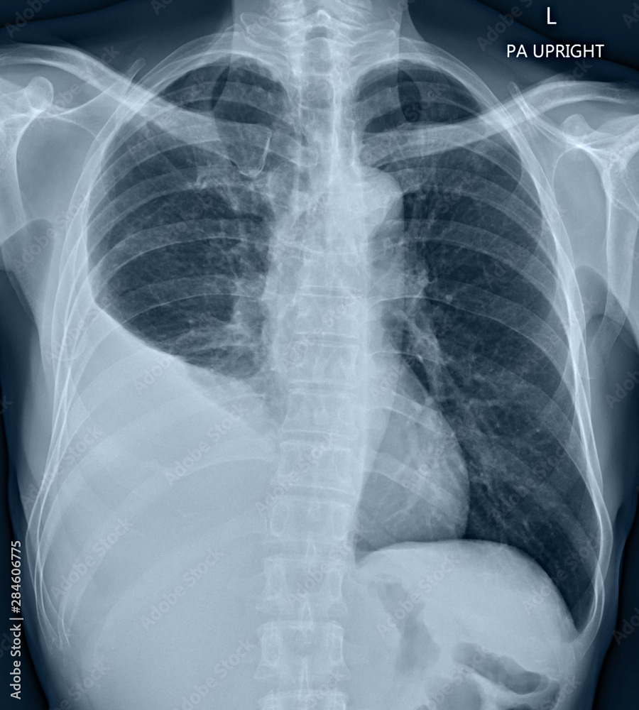 Chest X Ray Pleural Effusion